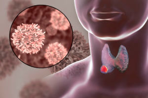 Thyroid cancer illustration
