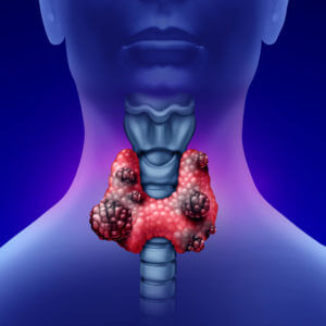 A 3D illustration showing cancer of the Thyroid.